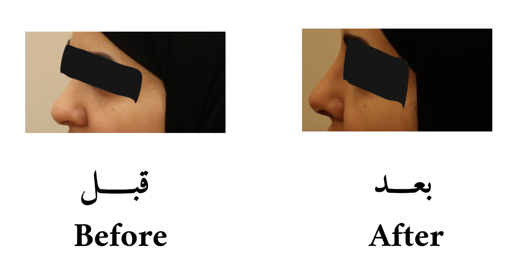 دكتور حسن الشمري عمليات تجميل و ترميم الانف إزالة حدبة الأنف الخارجية مع تعديل زوايا الأنف لاعطاء الأنف شكل طبيعي