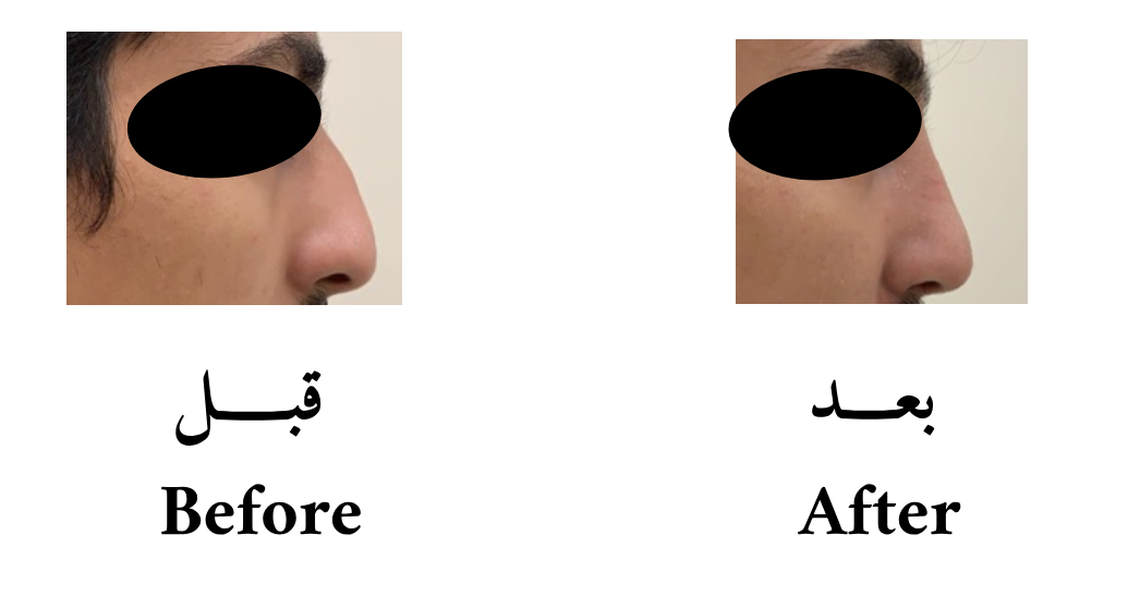 دكتور حسن الشمري عمليات تجميل و ترميم الانف تعديل جسور الأنف الجانبية لإعطاء الأنف مركز وسط الوجه